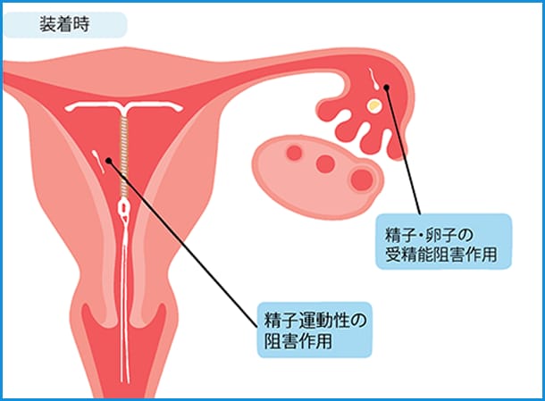 銅付加IUD(子宮内避妊具)を装着する