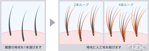 増毛の方法