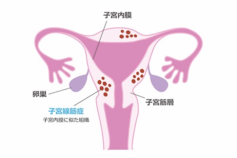 生理痛の症状がひどいときはどうしたらいい 原因と対処法 病院に行く目安 生理痛の症状がひどいときはどうしたらいい 原因と対処法 病院に行く目安